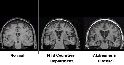 정상인과 치매 환자의 뇌 촬영 사진, 출처 MAYO Clinic