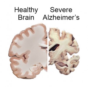 건강한 뇌와 알츠하이머병에 걸린 뇌를 비교한 사진, 출처 - somaliddf