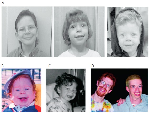 윌리암스 증후군을 앓는  사람들의 모습. 과연 유전병을 예측할 수 있을까? 출처 : Wikimedia Commons