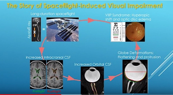 우주비행에 따른 뇌척수액 변화로 인해 안구 및 시각에 이상이 생길 수 있어요. 출처: 유튜브/The Healthcare Channel