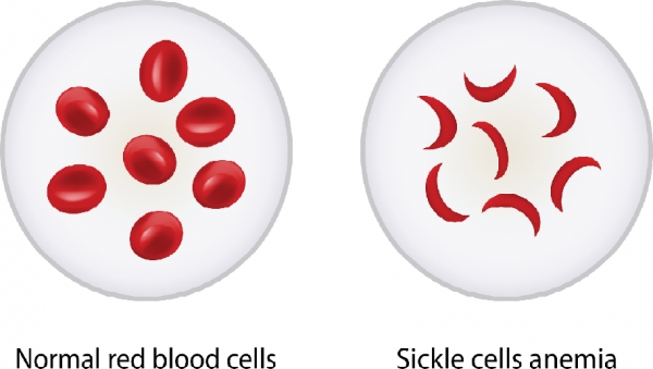 정상 적혈구와 낫 모양 적혈구 비교. 출처: fotolia
