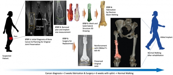 3D 프린팅 Ti-6Al-4V 임플란트(인공 뼈)를 이용한 골종양 치료 진행과정. 1단계: 뼈암의 최초진단 및 관절보전을 위한 수술 기획. 2단계: 종양절제범위 계획 및 그에 따른 골결손 크기 측정. 3단계: 메쉬&솔리드 하이브리드 구조의 임플란트 설계. 4단계: Ti-6Al-4V소재의 임플란트를 EBM 방식으로 제작. 5단계: 제작된 임플란트를 환자의 뼈가 제거된 부위에 삽입하고 봉합. 출처 : UNIST