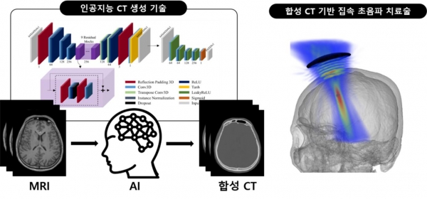인공지능 합성 CT 기반 집속 초음파 치료술 모식도. 출처 : KIST